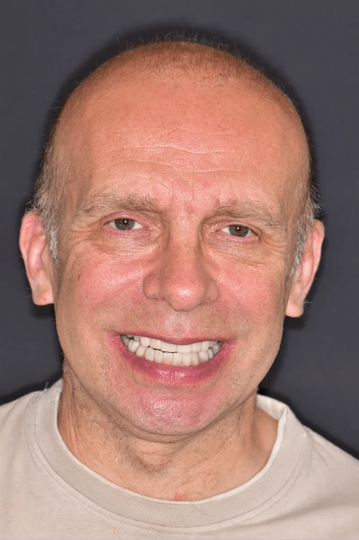 Full Mouth Rehabilitation in Norwich after photo