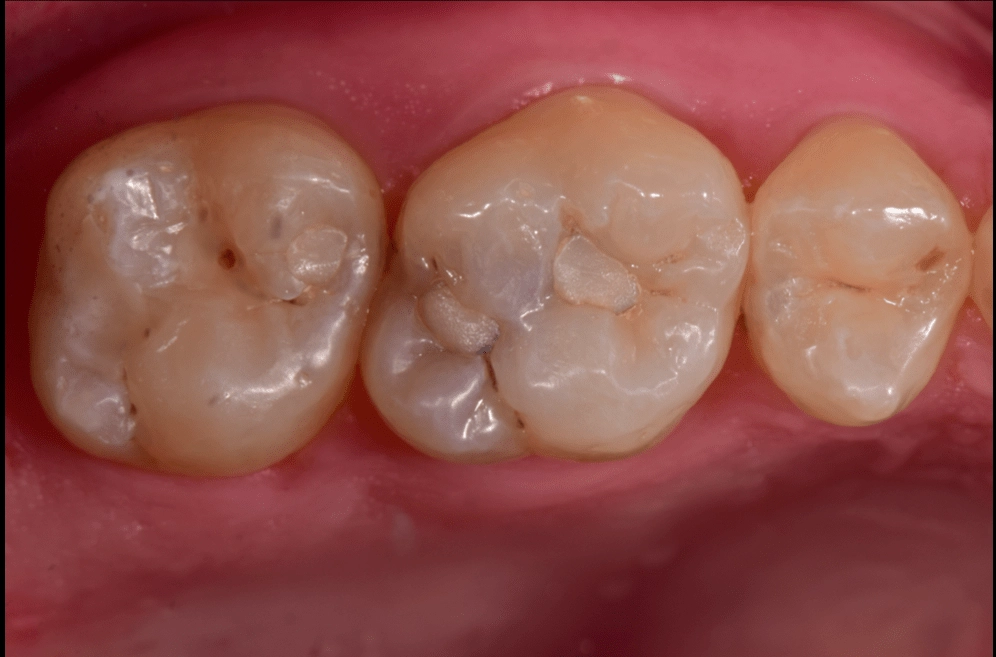 Before treatment photo