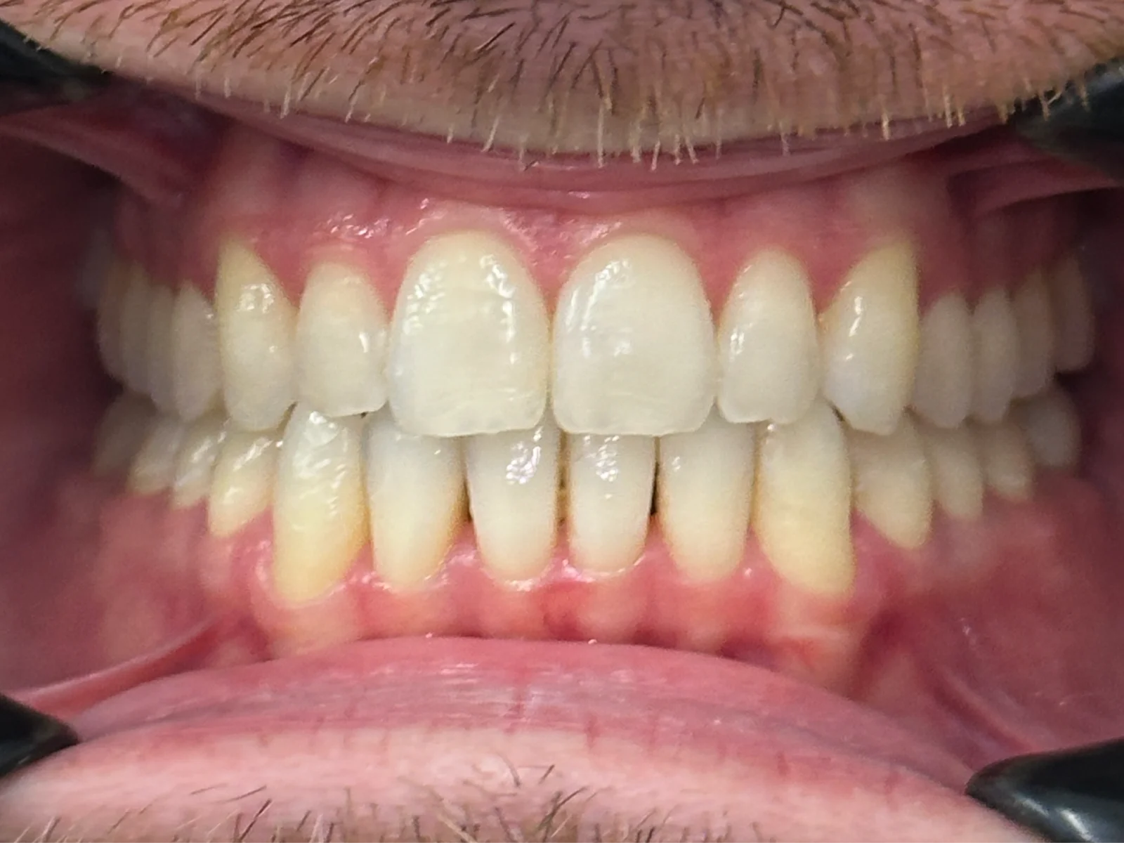 Transforming Smiles and Confidence: An Invisalign Case Study at Taverham Dental after photo