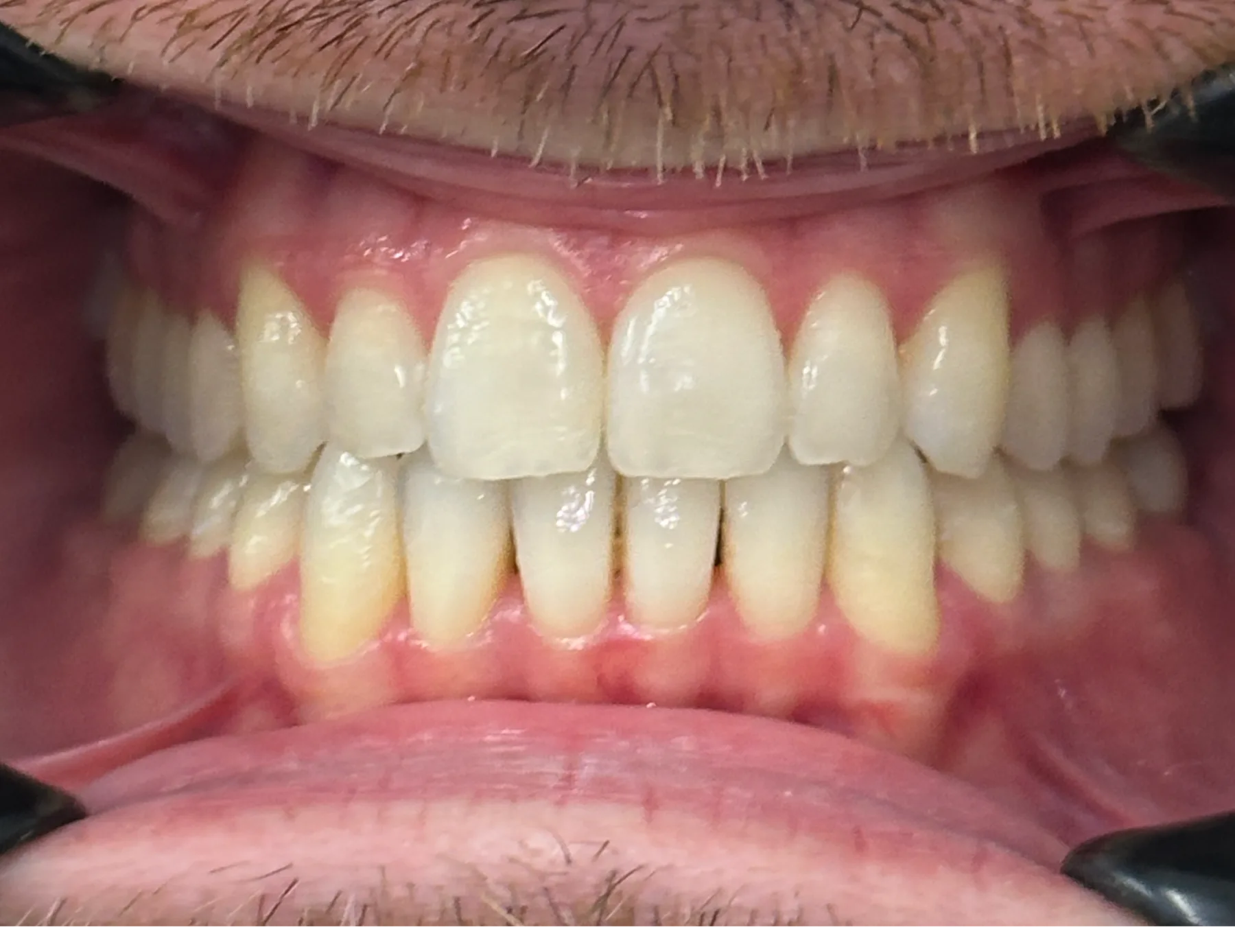 After photo of a patient having received Invisalign treatment at Taverham Dental
